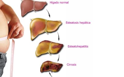 El hígado graso o esteatosis hepática