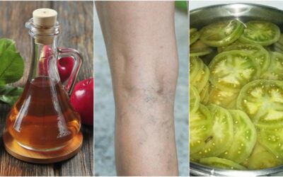 VINAGRE DE MANZANA PARA ARAÑAS VASCULARES