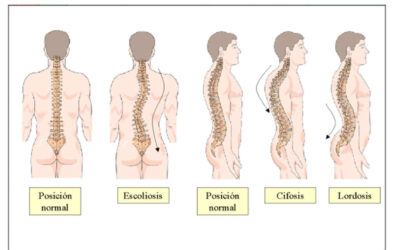 Las desalineación Vertebral y sus molestias