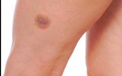 ¿Qué hacer con la pesadez en las piernas?